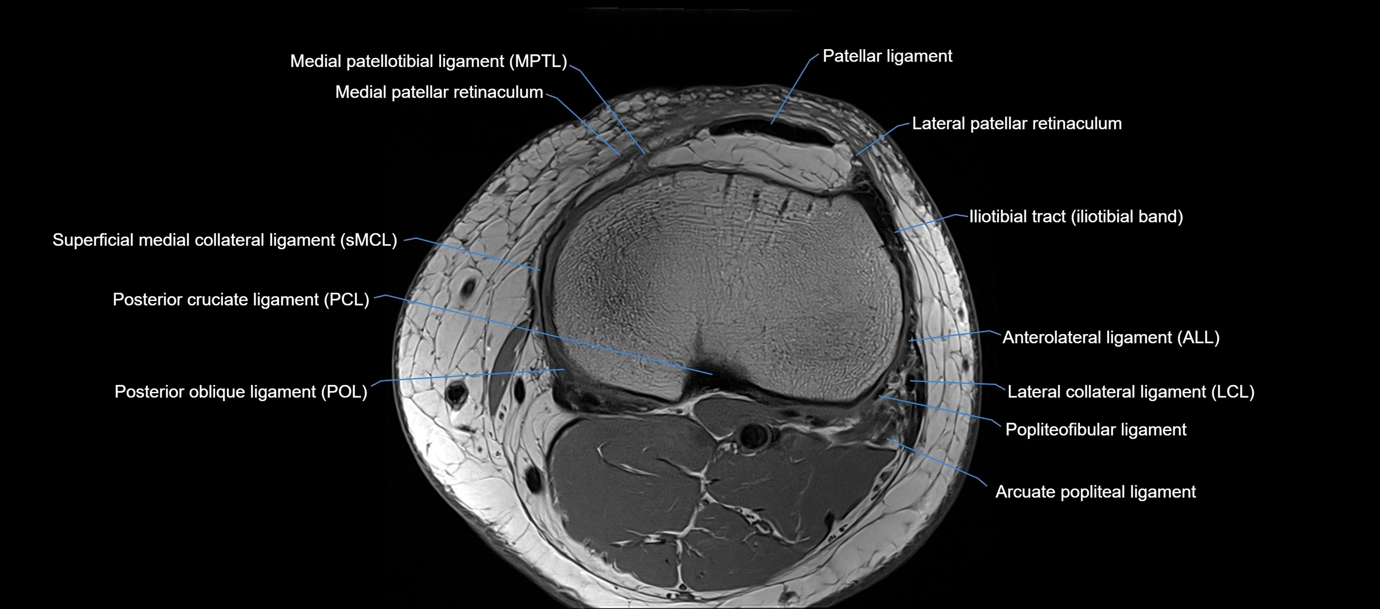 MRI Knee axial  ligaments cross sectional anatomy 3T  radiology  image-img-03001-00034.webp
